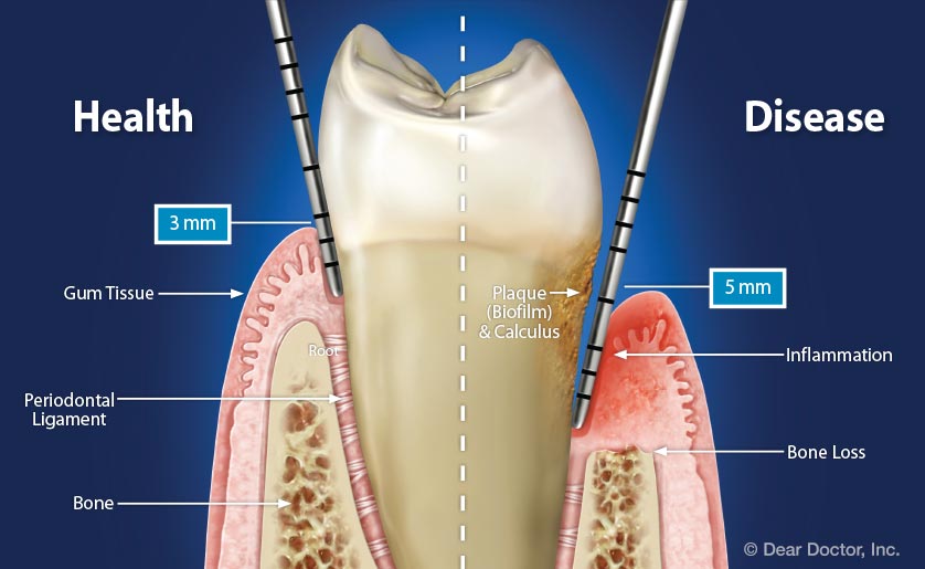 health vs disease periodontal